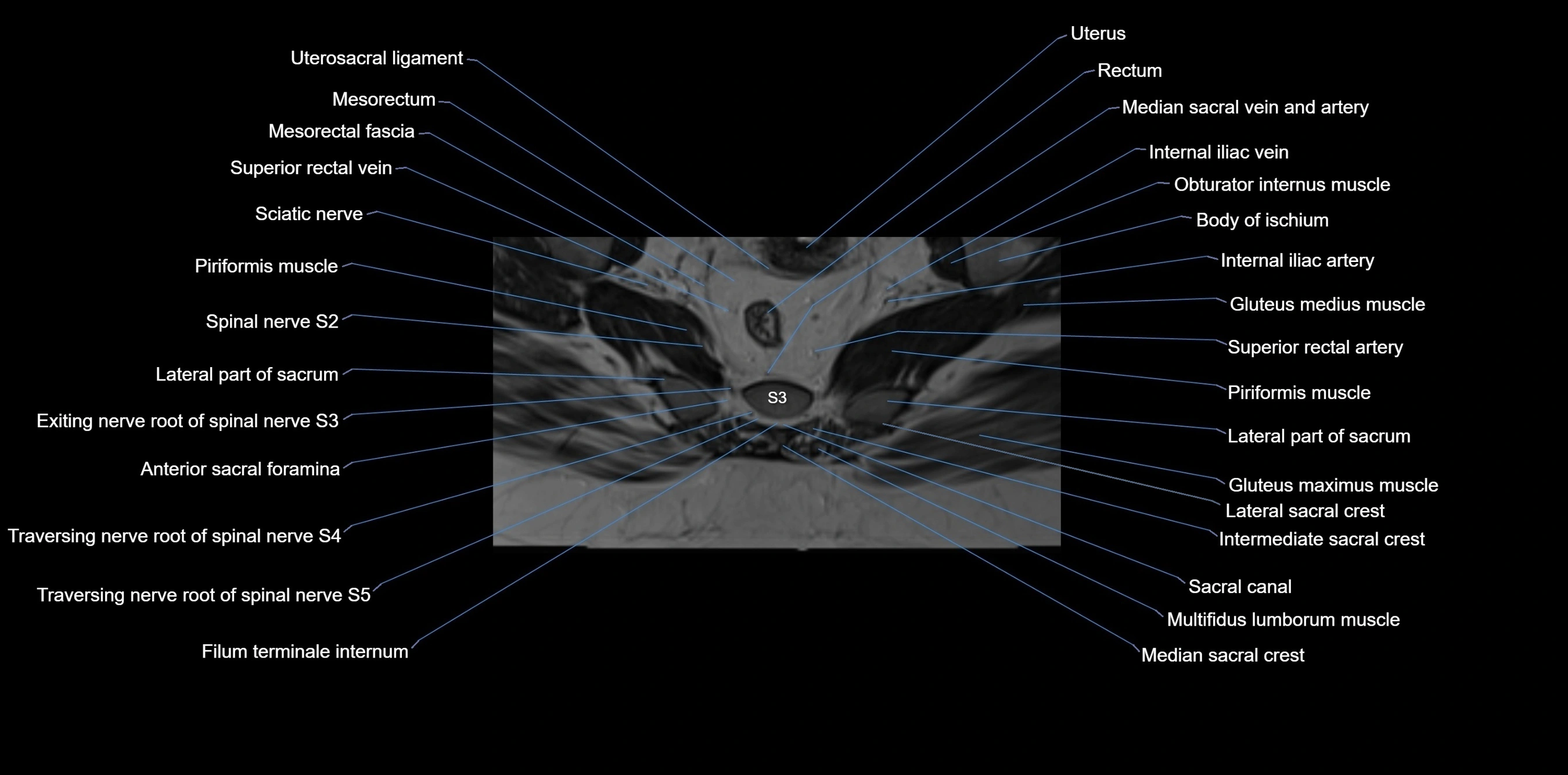MRI sacrum, coccyx and sacroiliac joint axial cross sectional anatomy 3T  radiology  image-img-00001-00042.webp
